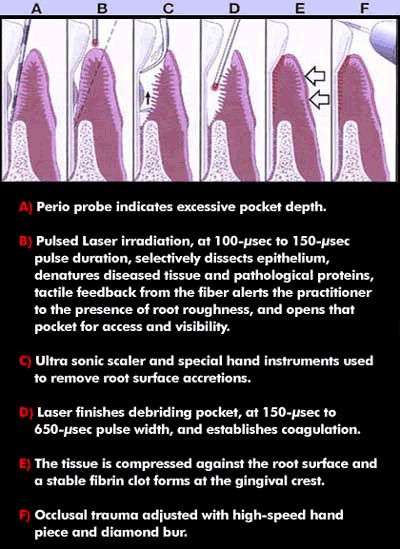The LANAP process