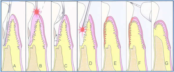 Laser Periodontal Therapy with Dr. Boretsky