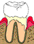 moderate perio